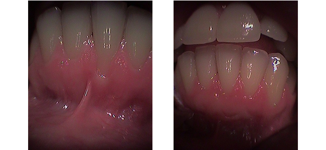Recession and Tissue Graft
