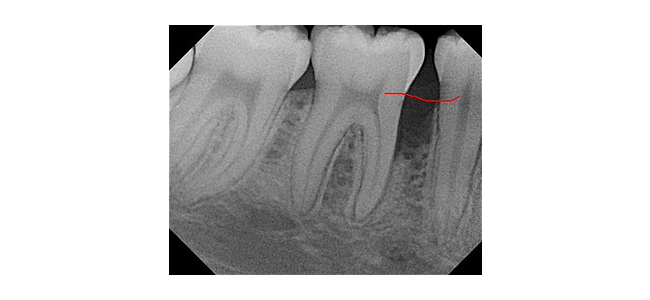 Bone graft- red line depicts where bone level should be