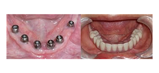 Implants before and after